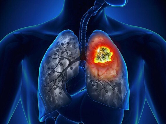 UNG THƯ PHỔI: DẤU HIỆU NHẬN BIẾT VÀ CÁC PHƯƠNG PHÁP CHẨN ĐOÁNBigemax được chỉ định cho bệnh nhân ung thư phổi không phải tế bào nhỏ