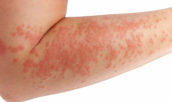 Eczema có thể gặp ở một số ít bệnh nhân sử dụng Biafine