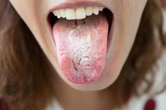 Thuốc có thể gây tác dụng phụ nấm candida miệng