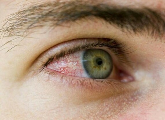 Thuốc được chỉ định dùng trong các trường hợp viêm nhiễm ở mắt