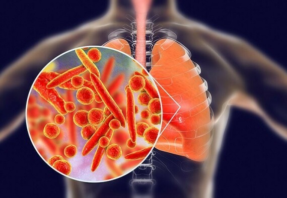 Binoclar được dùng trong điều trị viêm phổi do vi khuẩn nhạy cảm gây ra
