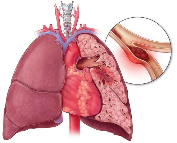 Thuốc chỉ định trong điều trị huyết khối phổi