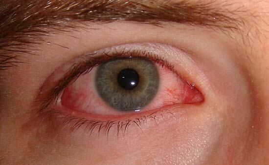 Hình: Thuốc được chỉ định điều trị viêm kết mạc mắt do vi khuẩn nhạy cảm với Tobramycin. Nguồn: Encyclopedia Britannica