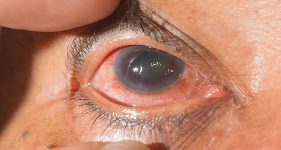 Dorlamida được dùng nhỏ mắt trong điều trị tăng nhãn áp do bệnh lý Glocom