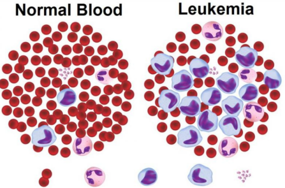 Hình ảnh tế bào máu trong bệnh bạch cầu mãn tính