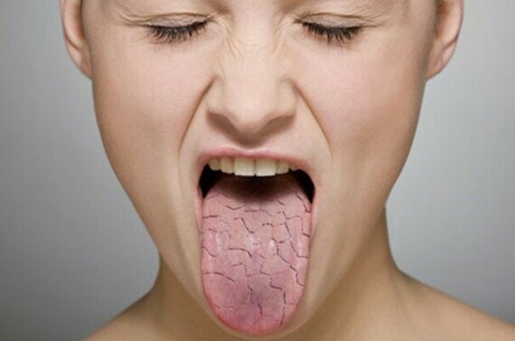 Khô miệng là tác dụng phụ thường gặp khi sử dụng thuốc