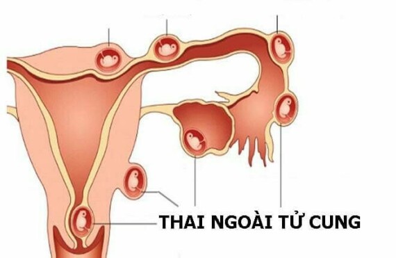 Thai ngoài tử cung là tác dụng phụ có thể gặp