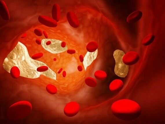 Deltasim 10 điều trị tăng cholesterol huyết