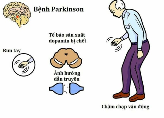Thước được chỉ định điều trị của tất cả các dạng Parkinson