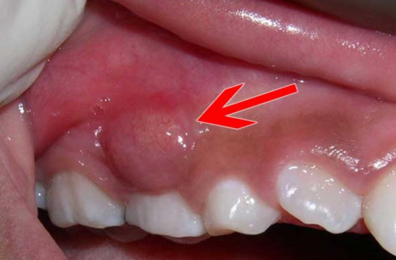 Daphazyl được dùng để điều trị nhiễm trùng răng miệng gây ra do vi khuẩn nhạy cảm gây ra