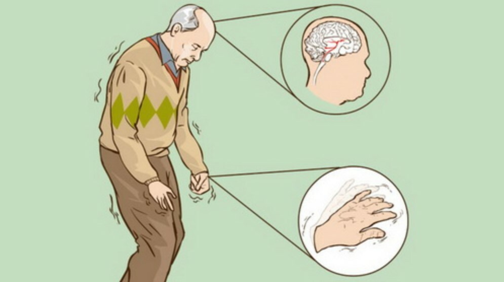 Levodopa thường dùng để điều trị các hội chứng Parkinson