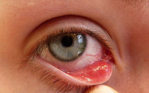 Decinfort Oph là thuốc nhỏ điều trị viêm nhiễm ở mắt như viêm bờ mi, viêm kết mạc.